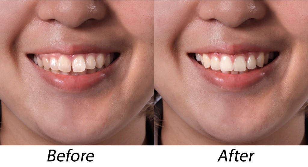 Before and after dental treatment: side-by-side smile comparison with before and after labels.